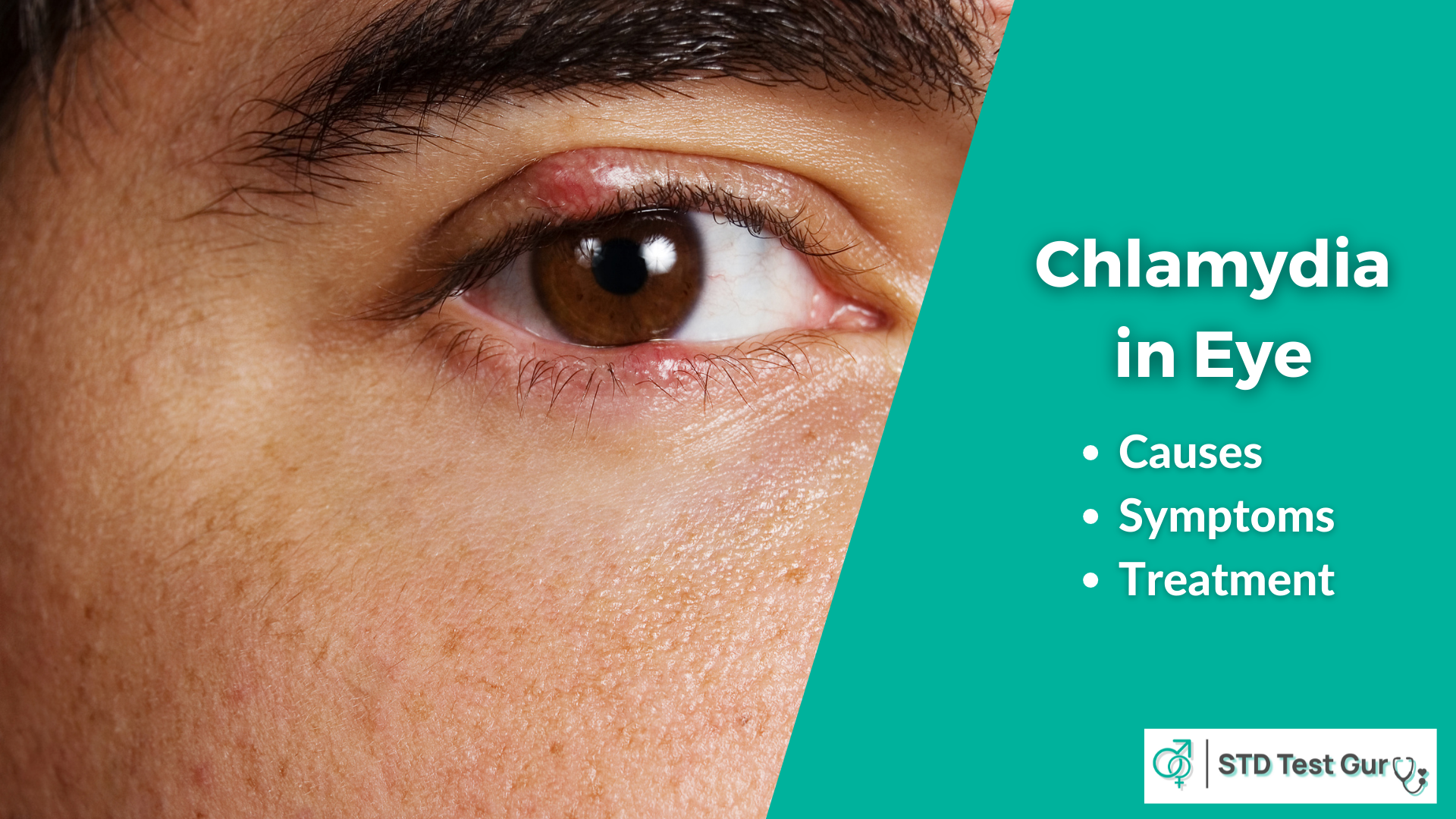 Chlamydia in Eye Symptoms and Causes - STDTestGuru
